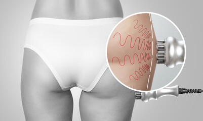 The procedure of rf lifting on the hips and buttocks of women and body fat. Obesity treatment.