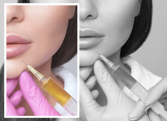 Cosmetologist does prp therapy anti wrinkle and aging skin on the chin and on the face of a...