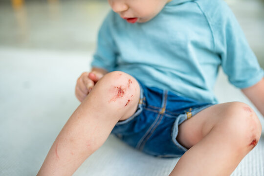 Toddler Boy With Scraped Knees. Parent Helping Her Child Perform First Aid Knee Injury After An Accident.