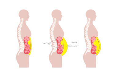 Visceral fat diagram