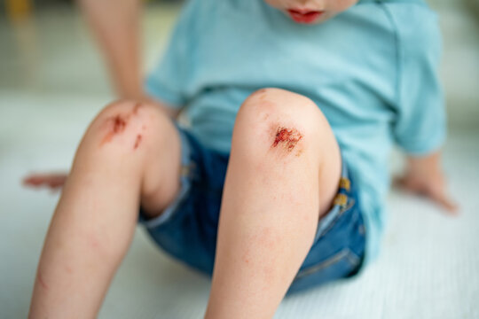 Toddler boy with scraped knees. Parent helping her child perform first aid knee injury after an accident.
