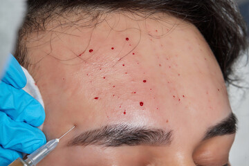 Injection at spa salon. Doctor hands in gloves. Closeup. Pretty male patient. Beauty treatment....