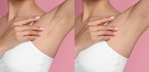 Before and after epilation. Collage with photos of woman showing armpit on pink background, closeup