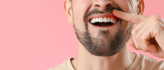 Man with gum inflammation on pink background, closeup - obrazy, fototapety, plakaty