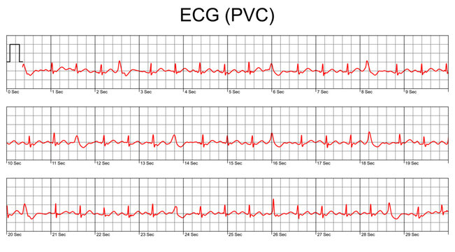 ECG cardiogram.Cardiac Arrhythmia. Premature Ventricular Contraction (PVC). Cardiogram on a white background. Vector illustration.