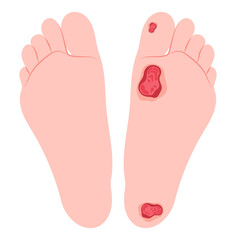 Charcot conduction velocity screening in leg feet limb pain injury nerve clot damage of bacteria sensory gout glucose plaque fat high sugar blister tingling test callus corn stroke Diabetic