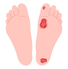 Charcot conduction velocity screening in leg feet limb pain injury nerve clot damage of bacteria sensory gout glucose plaque fat high sugar blister tingling test callus corn stroke Diabetic