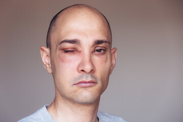 Fototapeta premium Caucasian man has angioedema around the eyes caused by allergic reaction to agents such as insect bites, foods, or medications. Swollen face.