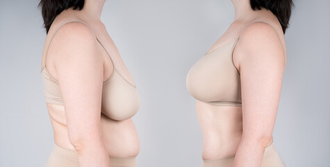 Before and after breast augmentation concept, woman with very large silicone breasts after...