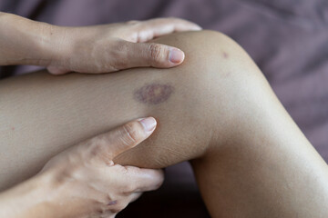 Woman having scar and scraped knee.