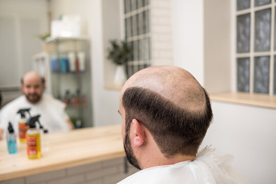 bald man waiting for his hair prosthesis to be placed in an esthetic c