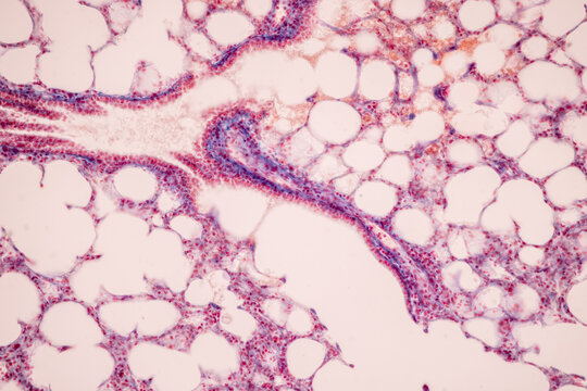Human lung pathology under light microscope, The lungs is organs of the respiratory system in humans.