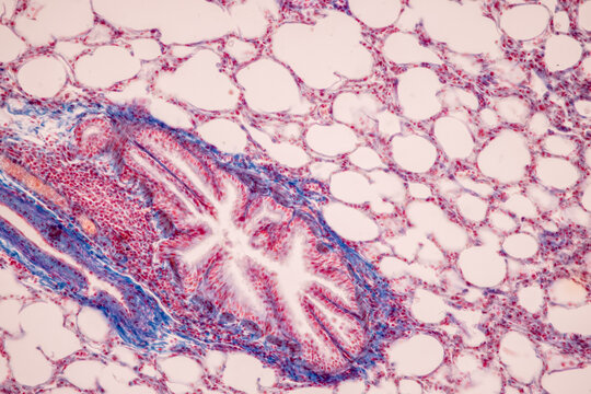 Human lung pathology under light microscope, The lungs is organs of the respiratory system in humans.