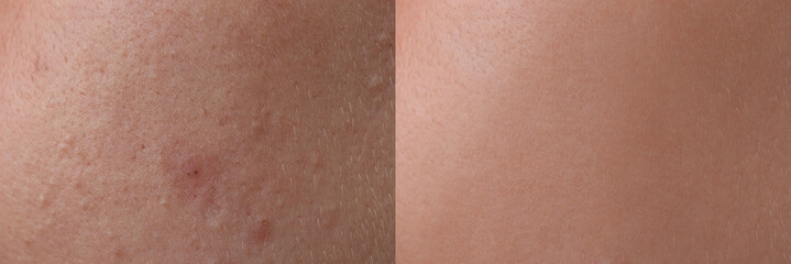Fototapeta premium Collage with photos of person suffering from acne before and after treatment, closeup. Banner design showing affected and healthy skin