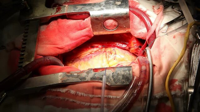 Open heart surgery. Heart surgery. Heart transplantation from a donor. 