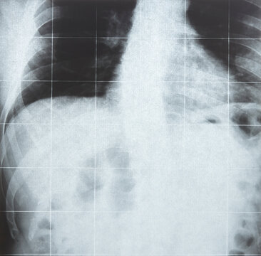 X-Rays imaging. Chest detail. Medical procedure diagnosis. Illness