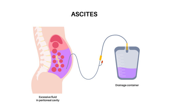 Abdominal paracentesis poster