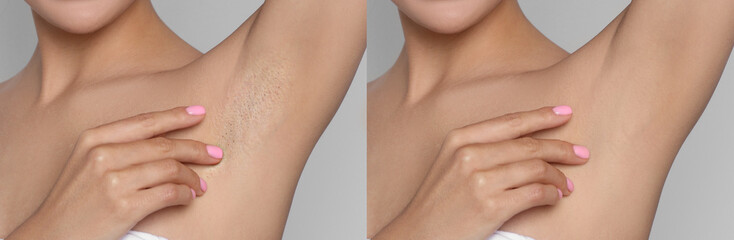 Before and after epilation. Collage with photos of woman showing armpit on light background, closeup - obrazy, fototapety, plakaty
