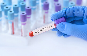 The doctor holds a test blood sample tube with hepatitis C virus (HCV) test on the background of medical test tubes
