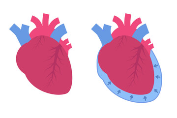 Pericardial effusion concept. Cardiovascular system medical vector illustration. - obrazy, fototapety, plakaty