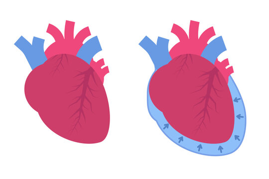 Pericardial effusion concept. Cardiovascular system medical vector illustration.