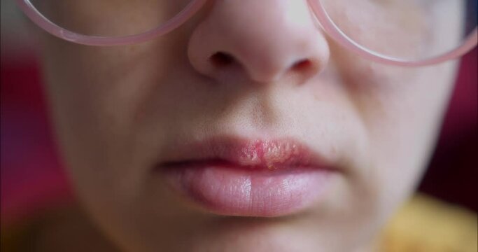 Herpes Sore On Female Lips Vesicles