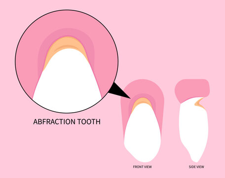 Toothache in dentistry with abfraction disease of teeth fracture crack broken and Bad breath grinding pain syndrome	