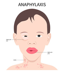 Face swollen and bee sting the Epinephrine Anaphylaxis allergy drug dose adrenaline of allergen nut syringe treat life threatening in septic heart failure © Pepermpron