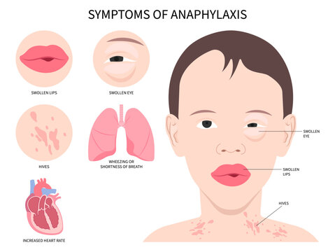 Anaphylaxis allergy Face swollen and bee sting the Epinephrine drug dose adrenaline of allergen nut syringe treat life threatening in septic heart failure