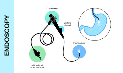 Gastroscopy endoscopy procedure - obrazy, fototapety, plakaty