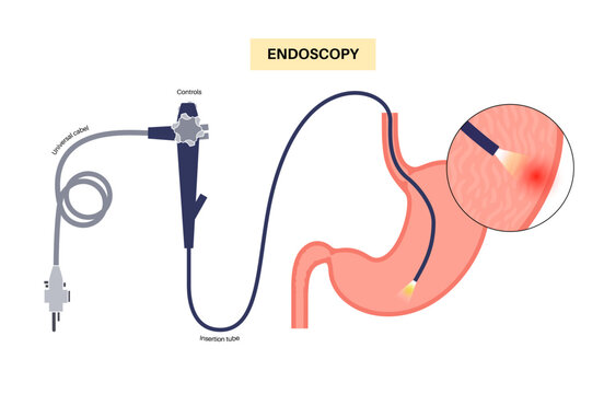 Gastroscopy endoscopy procedure