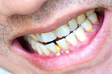 Tooth's a man smoking bad. woman smokes a cigarettes have tooth decay and calculus on teeth, So we...