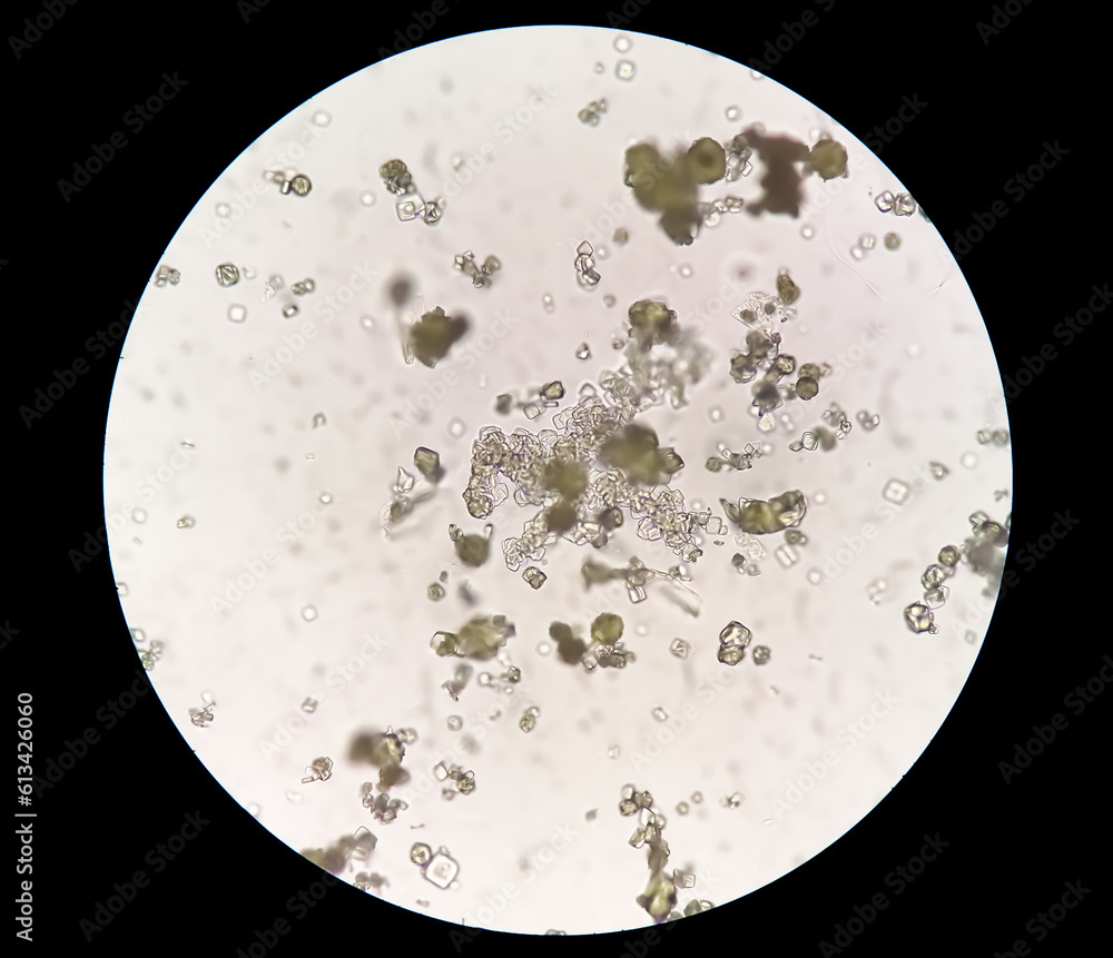 Poster Uric acid crystal, Calcium oxalate dihydrate in urine sediment.