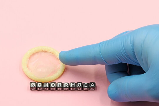Doctor's hand pointing to a condom. Combating sexually transmitted diseases