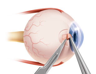 image depicting filtering microsurgery in the treatment of glaucoma