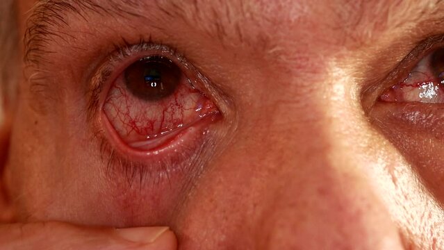 Senior Man with a pink eye infection in one of his eyes