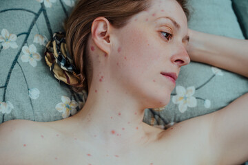 Woman with chicken pox lying in bed portrait