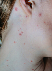 Close-up of a woman with chicken pox
