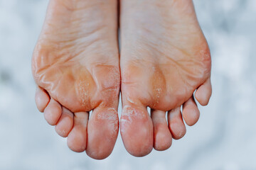 Unkempt woman feet, woman feet without pedicure - obrazy, fototapety, plakaty