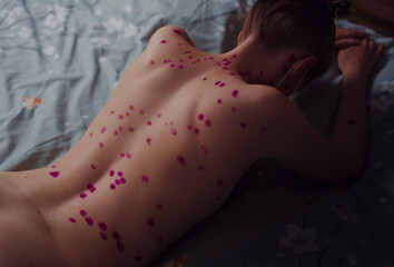 Woman with chicken pox lying on bed