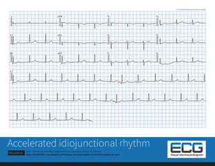 Male, 76 years old, clinically diagnosed with coronary heart disease. ECG showed that sinus rhythm and rapid junctional rhythm alternate, with the latter being the predominant.