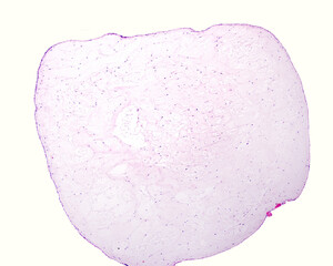 Hydatidiform mole