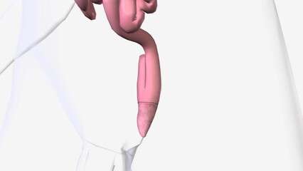 Ileoanal anastomosis is most often used to treat chronic ulcerative colitis and inherited conditions, such as familial adenomatous polyposis