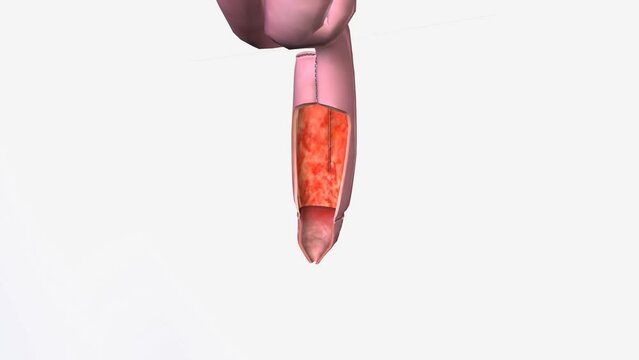 Pouchitis is inflammation that occurs in the lining of a pouch created during surgery to treat ulcerative colitis or certain other diseases.