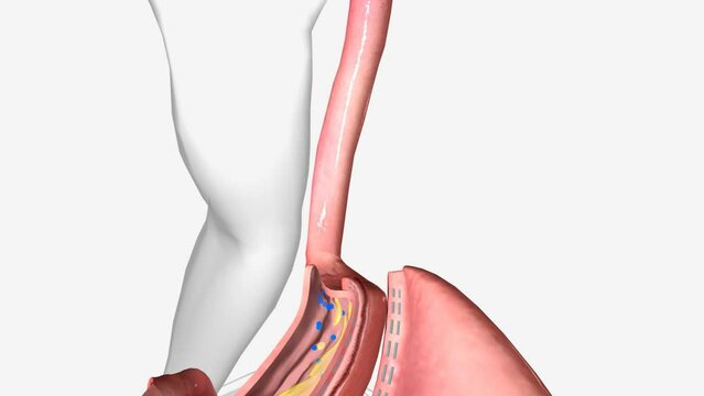 Sleeve Gastrectomy, Esophagus 3d animation