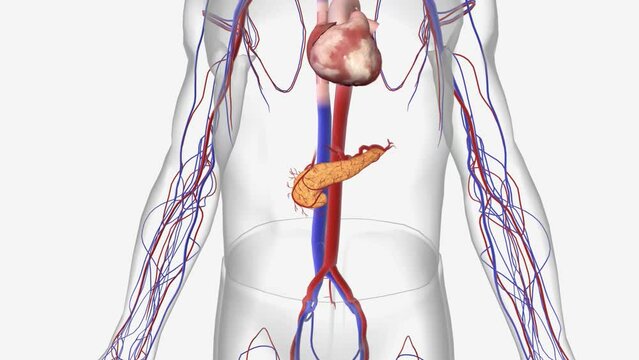 pancreatic adenocarcinoma or pancreatic exocrine cancer. Less frequently, cancer can form in the hormone-producing