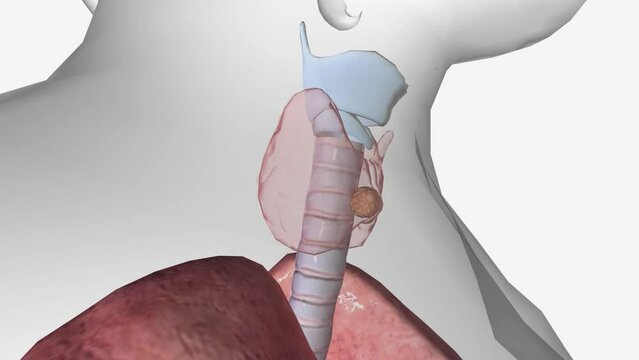 Thyroid Cancer Stage 2 The primary tumor can be any size and the cancer may or may not have spread to lymph nodes,