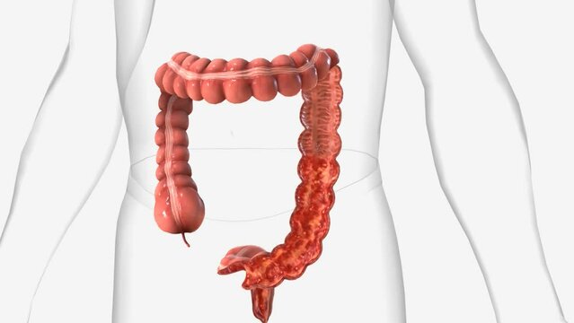 Ulcerative colitis is an inflammatory bowel disease that causes inflammation and ulcers (sores) in your digestive tract