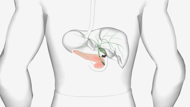 In gallstone pancreatitis, (also called biliary pancreatitis,) a gallstone is blocking the pancreatic duct
