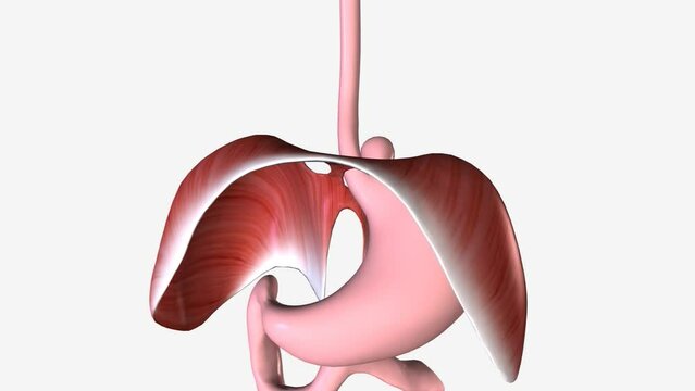 Paraesophageal hernia or hiatal hernia occurs when a portion of the stomach protrudes through the esophageal hiatus into the chest cavity.